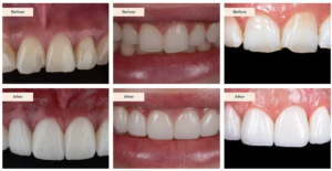 composite bonding cost London